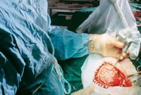 Médicos implantam osso do crânio na perna para removerem tumor cerebral