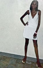 Mais uma modelo, vítima de anorexia, morreu no Brasil