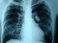 ONU preocupado com nova forma de tuberculose