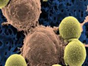 Leucemia: Nanotecnologia aumenta a sobrevivência