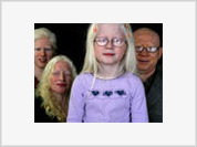 Albinos são mortos para feitiçaria