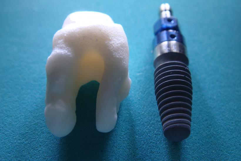 Root analogue ceramic dental implant vs titanium screw type implant