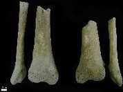 Primeiro caso no mundo: esqueletos medievais com amputações