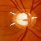 Glaucoma avança entre mais jovens