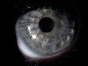 Transplante de córnea cresce 7,8%