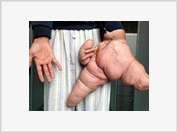 Homem com a maior mão do mundo espera a cirurgia