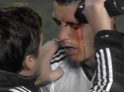 Cristiano Ronaldo sofre  lesão grave no olho