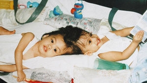 Gêmeos siameses. 10 anos após a cirurgia